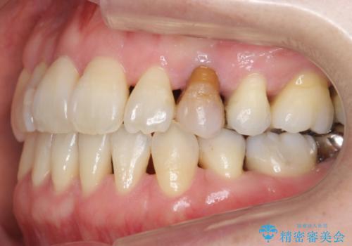 前歯のセラミッククラウン　犬歯に相当する部位に自然にの治療前