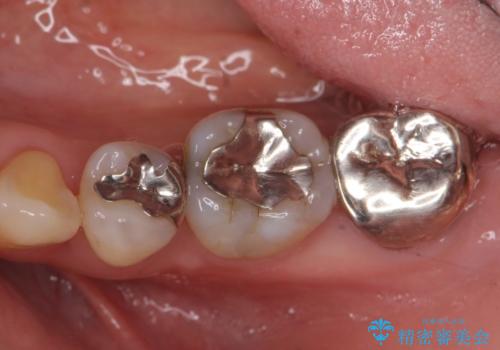 銀歯を白く　セラミックインレーにの症例 治療前