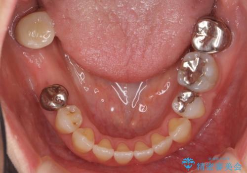 奥歯のブリッジを白く　矯正含めた総合治療で、歯周病、根の問題、一気に解決の治療中