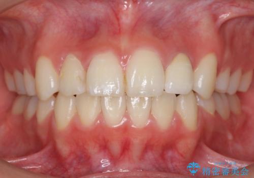 ホワイトニングとセラミックで前歯を白く　の症例 治療後