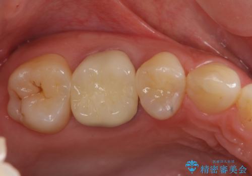 奥歯の歯の間の虫歯の治療　セラミッククラウンおよびセラミックインレーの治療後