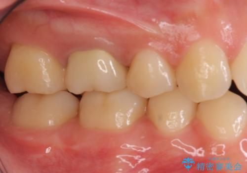 奥歯の歯の間の虫歯の治療　セラミッククラウンおよびセラミックインレーの治療後