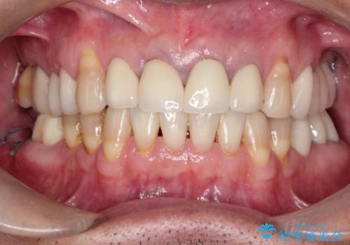 上の前歯を根の治療からの再補綴の治療後
