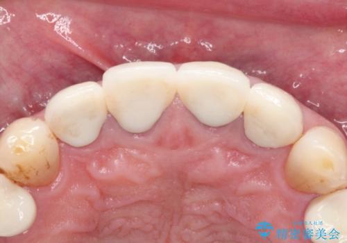 上の前歯を根の治療からの再補綴の治療後