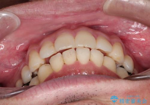 [30代男性] インビザラインで出っ歯の治療の治療後
