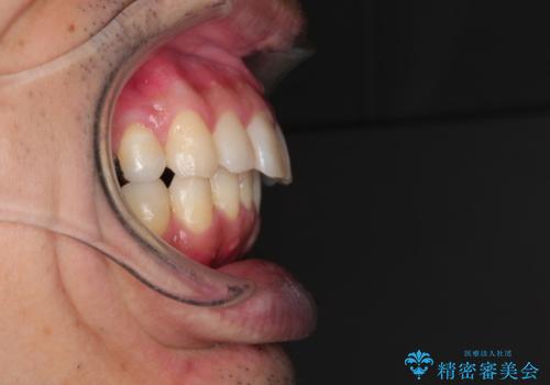 [30代男性] インビザラインで出っ歯の治療の治療後