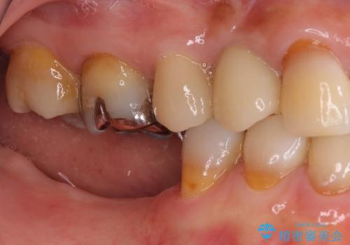 奥歯で咬めない　インプラントによる咬合回復①　骨造成　の治療前
