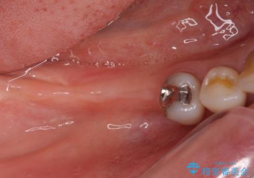 奥歯で咬めない　インプラントによる咬合回復①　骨造成　の症例 治療前