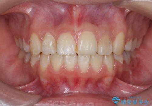 ホワイトニングとセラミックで前歯を白く　の治療前