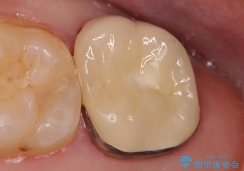 メタルボンドクラウン　虫歯治療の症例 治療後