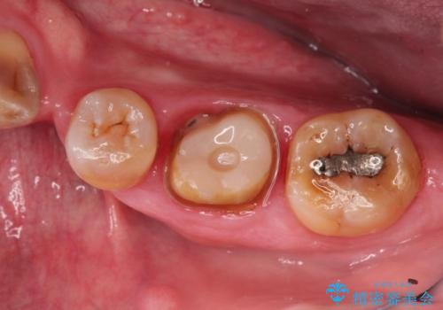中途半端な継ぎ接ぎの歯を、クラウンでしっかりと処置するの治療中