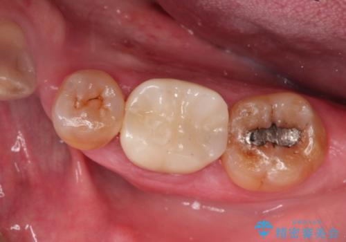 中途半端な継ぎ接ぎの歯を、クラウンでしっかりと処置するの治療後