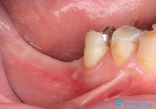 奥歯の喪失  骨造成を伴うインプラント咬合回復の症例 治療前