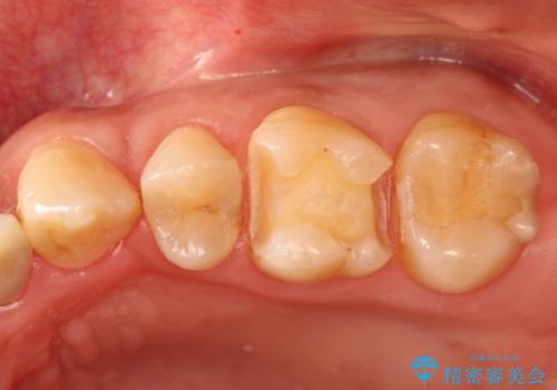銀歯のやり直し　虫歯治療　セラミックインレーに変更の治療中