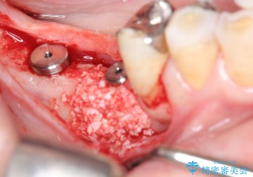 奥歯の喪失  骨造成を伴うインプラント咬合回復の治療中
