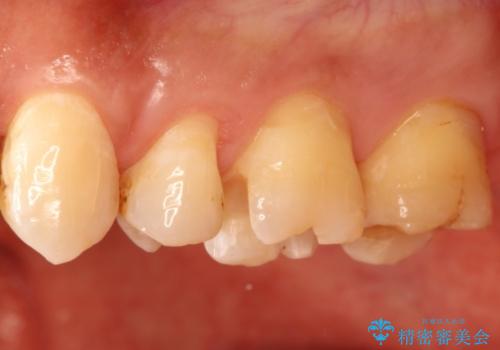銀歯のやり直し　虫歯治療　セラミックインレーに変更の治療中