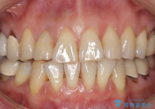 50代女性 加齢によって黄ばんだ歯を白く(スペシャルホワイトニング)の治療前