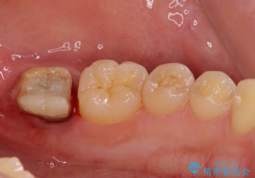 銀歯がすぐとれる　短い歯を長くするの治療後