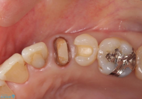 前歯のセラミッククラウン　犬歯に相当する部位に自然にの治療中