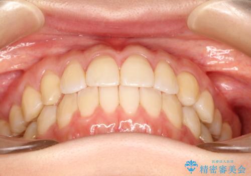 前歯の部分矯正　インビザラインエクスプレスパッケージの治療後