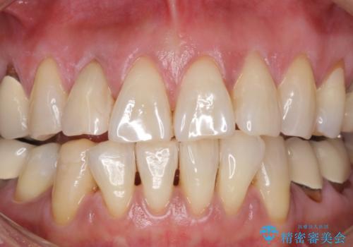 50代女性 加齢によって黄ばんだ歯を白く(スペシャルホワイトニング)の治療後
