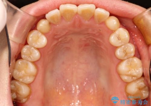 前歯の部分矯正　インビザラインエクスプレスパッケージの治療前
