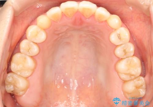 前歯の部分矯正　インビザラインエクスプレスパッケージの治療後