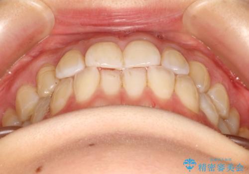 前歯の部分矯正　インビザラインエクスプレスパッケージの症例 治療前
