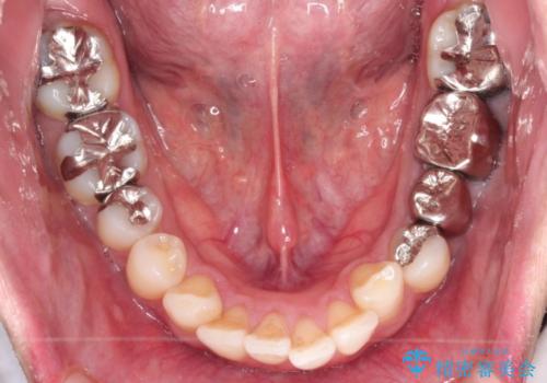 [30代男性] インビザラインで出っ歯の治療の治療前