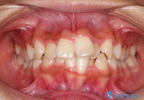 ガタガタの歯並びをインビザラインで美しくの症例 治療前