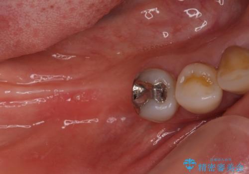 奥歯で咬めない　インプラントによる咬合回復①　骨造成　の症例 治療後