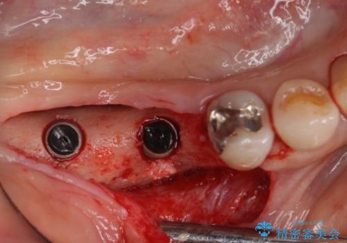 奥歯で咬めない　インプラントによる咬合回復①　骨造成　の治療後