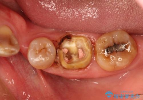 中途半端な継ぎ接ぎの歯を、クラウンでしっかりと処置する