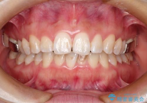 矯正中にPMTCとホワイトニングで歯を白くの症例 治療前