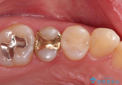 むし歯の再治療。セラミックインレーとゴールドインレーの症例 治療後