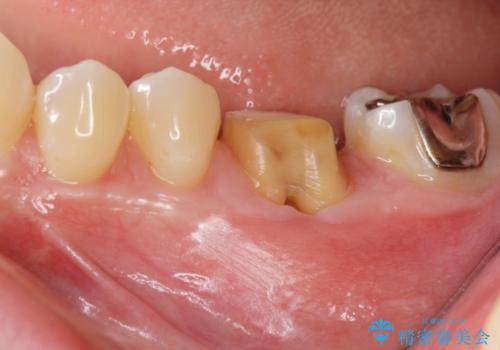 破折による欠損歯　ストローマン社製インプラントによる咬合回復の治療前