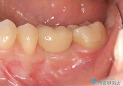 破折による欠損歯　ストローマン社製インプラントによる咬合回復の症例 治療後