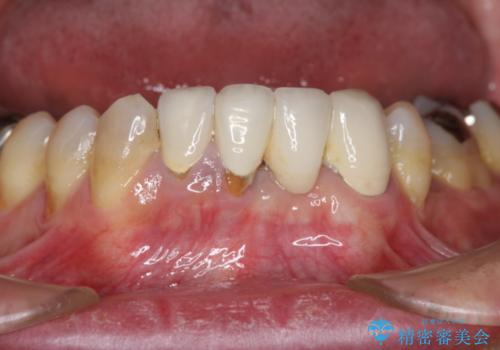 矯正治療を併用した前歯ブリッジの再作製の症例 治療前