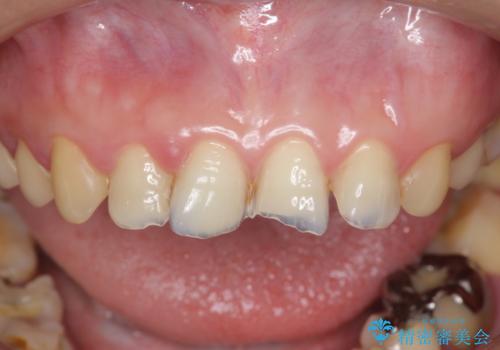 [酸蝕歯] オールセラミックジルコニアクラウン治療の治療前
