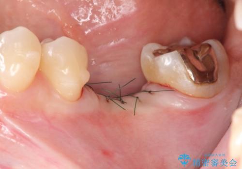 破折による欠損歯　ストローマン社製インプラントによる咬合回復の治療中