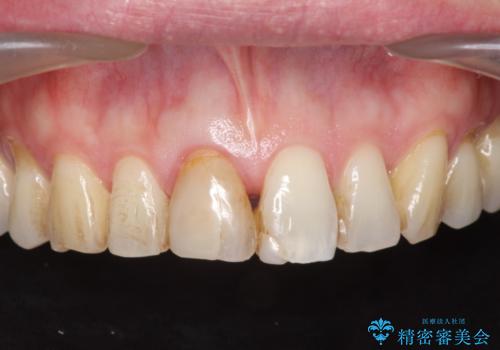 神経の死んだ前歯のレジン修復の劣化　ジルコニアクラウンによる審美回復の症例 治療前