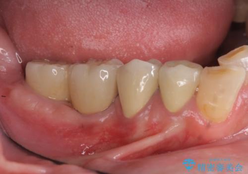 奥歯の喪失  骨造成を伴うインプラント咬合回復の症例 治療後