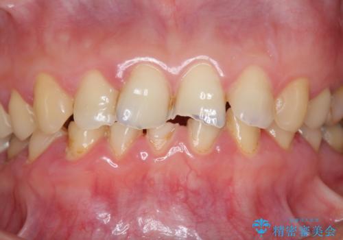 [酸蝕歯] オールセラミックジルコニアクラウン治療の症例 治療前