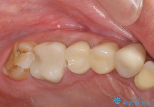 著しく腫れた歯ぐき　歯肉と歯の改善を行う歯周外科の治療前