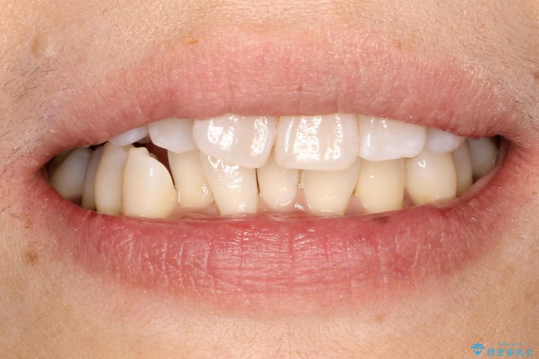 インビザラインによるかみ合わせの治療　奥歯の位置関係を是正してガタつきを治すの治療前（顔貌）