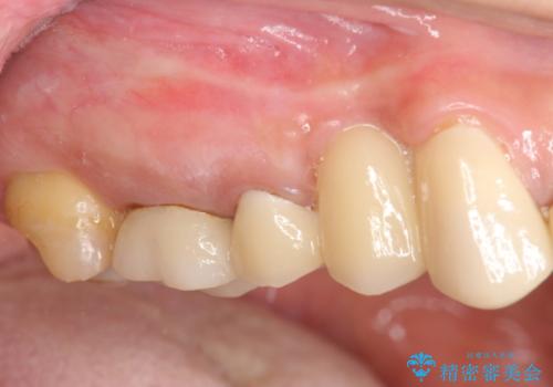 著しく腫れた歯ぐき　歯肉と歯の改善を行う歯周外科の症例 治療前
