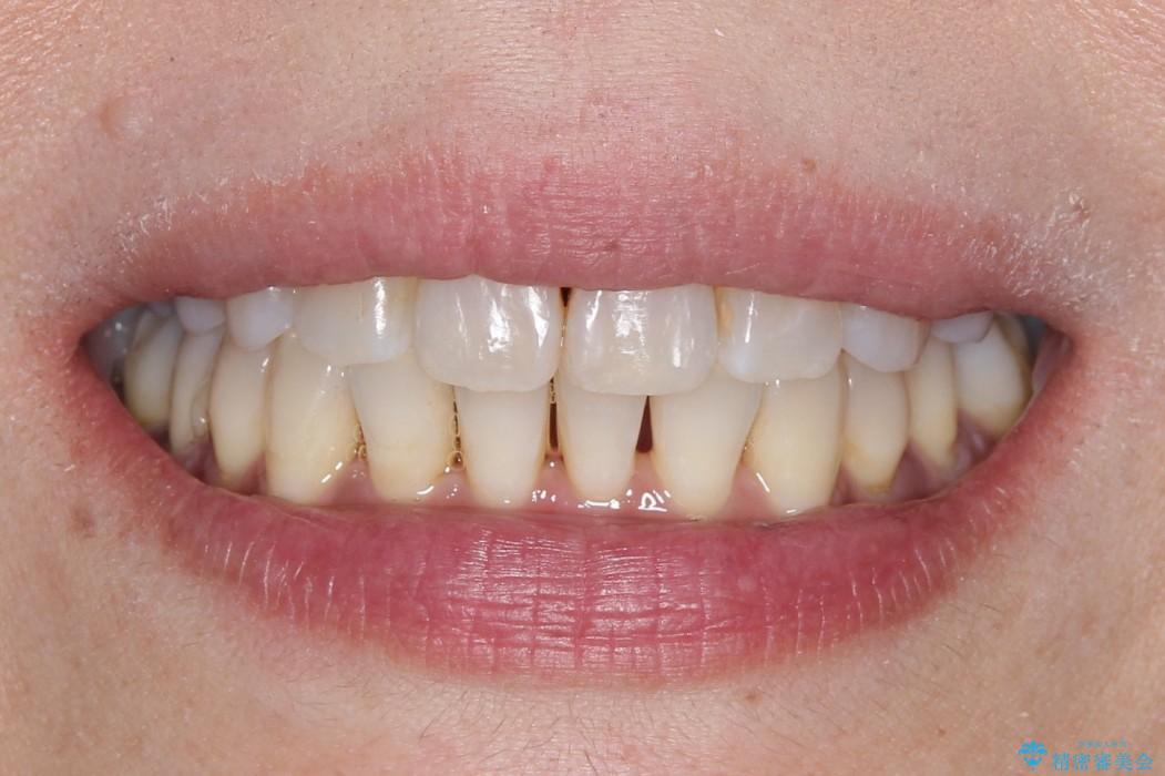 インビザラインによるかみ合わせの治療　奥歯の位置関係を是正してガタつきを治すの治療後（顔貌）