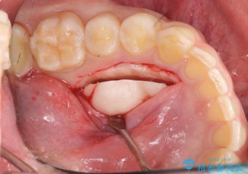 [骨の隆起で話しづらい]舌のスペースを確保する骨隆起切除術の治療中
