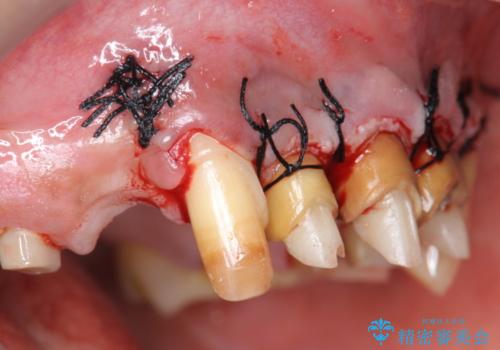 著しく腫れた歯ぐき　歯肉と歯の改善を行う歯周外科の治療中