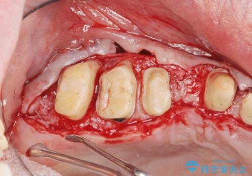 多発した縁下カリエス　歯周外科を併用する虫歯治療の治療中